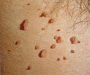 papillomavirus manusa dina kulit